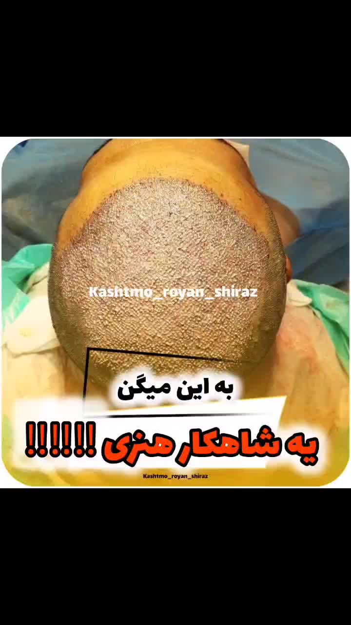 کاشت مو fueپلاس|خدمات آرایشگری و زیبایی|شیراز, قصرالدشت|دیوار