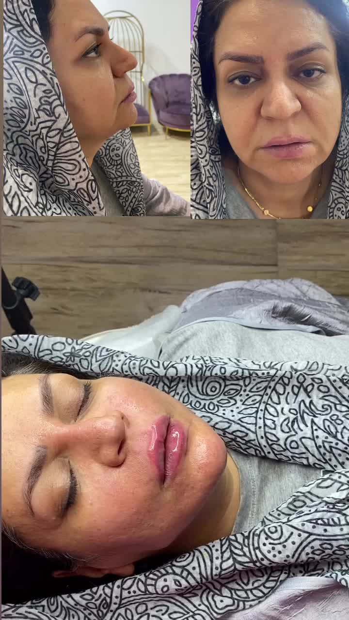 تخفیفات طلایی/ژل لب/ بوتاکس/ گونه/ فول فیس خط خنده|خدمات آرایشگری و زیبایی|مشهد, دانشجو|دیوار