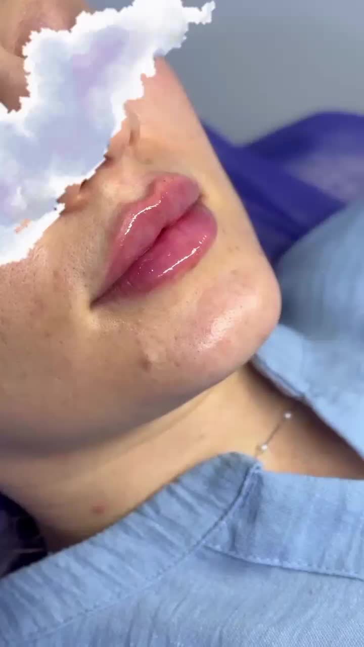 بوتاکس ژل لب خط خنده چانه گونه|خدمات آرایشگری و زیبایی|گرگان, |دیوار