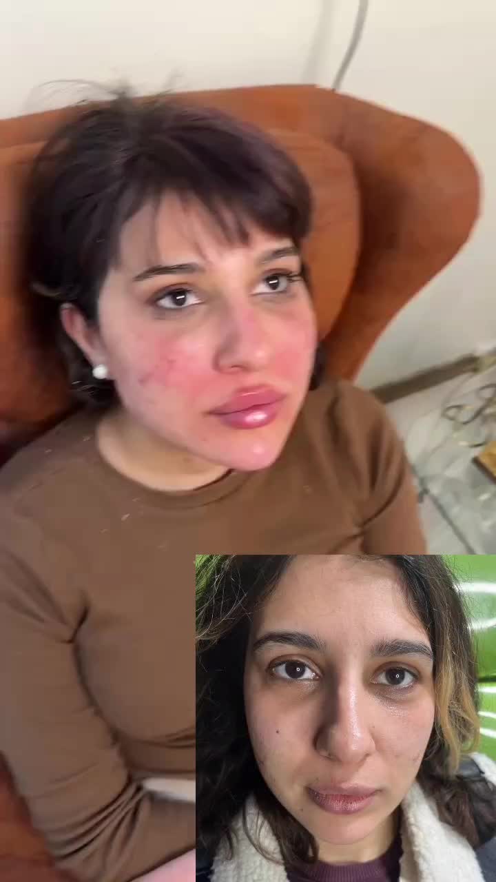 مدل برای درمان افتادگی های صورت و ژل لب و بوتاکس|خدمات آرایشگری و زیبایی|تهران, میرداماد|دیوار