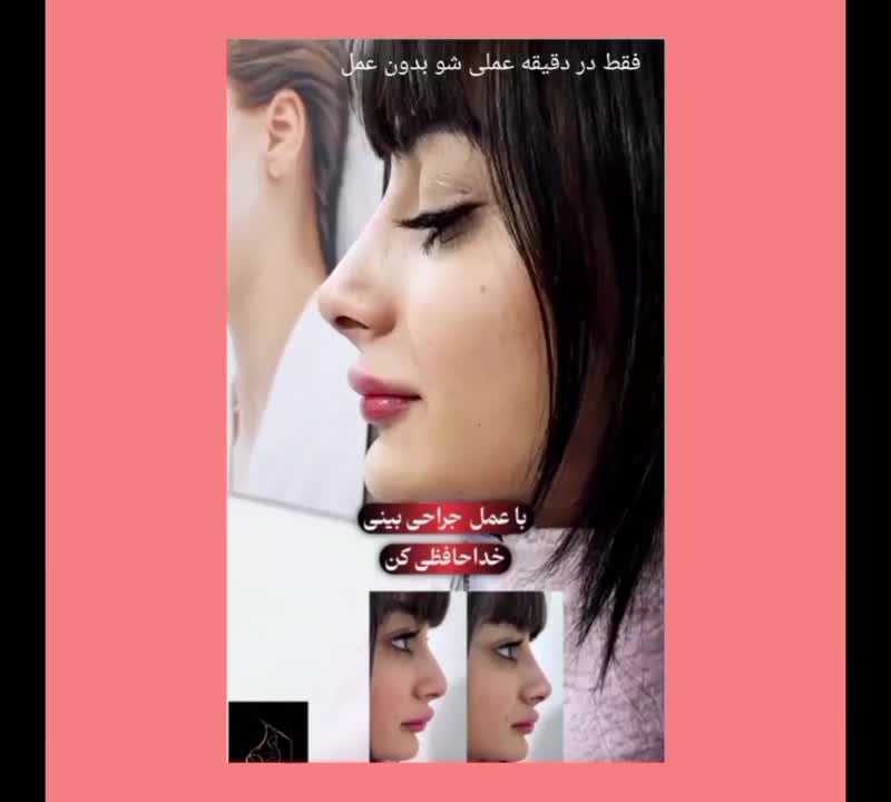 جشنواره50% ژل بوتاکس آنزیم خال مزو زگیل لابیا زگیل|خدمات آرایشگری و زیبایی|کرمانشاه, |دیوار