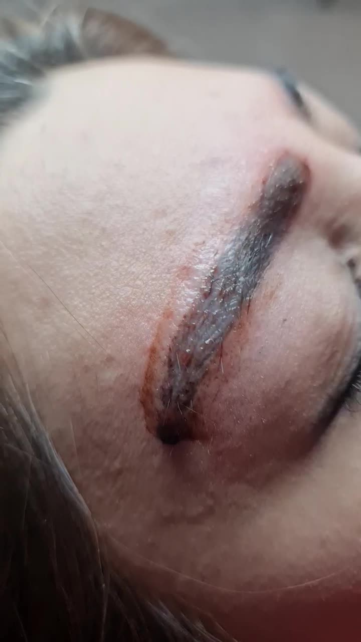 ریموو و پاک کردن تخصصی تاتو توسط مستر ریموو|خدمات آرایشگری و زیبایی|تهران, دهکده المپیک|دیوار