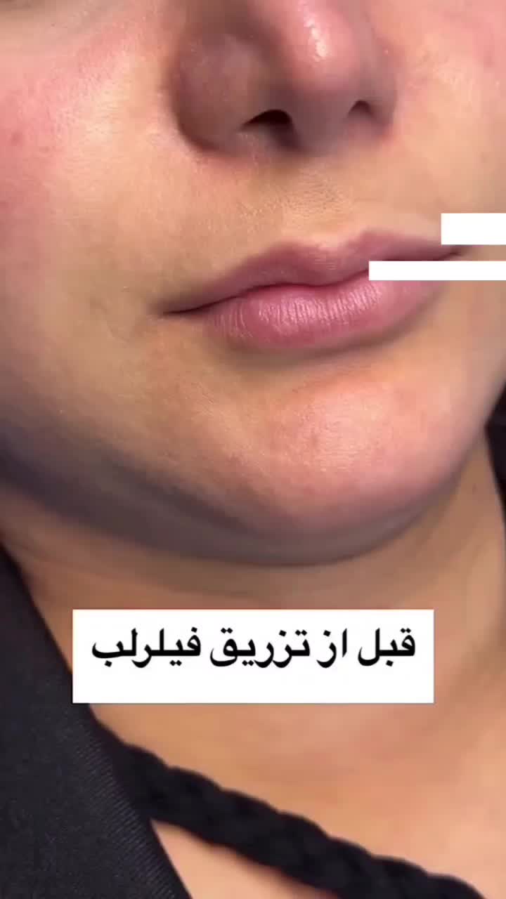 تزریق ژل و فیلر لب،گونه،چانه(جشنواره)درمطب فقط499ت|خدمات آرایشگری و زیبایی|اصفهان, باغ زیار|دیوار