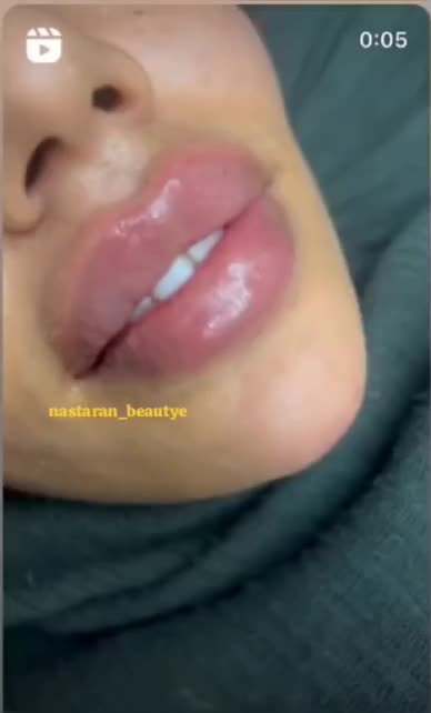 پاکسازی لیزرخالبرداری،توسط پزشک|خدمات آرایشگری و زیبایی|کارون, |دیوار