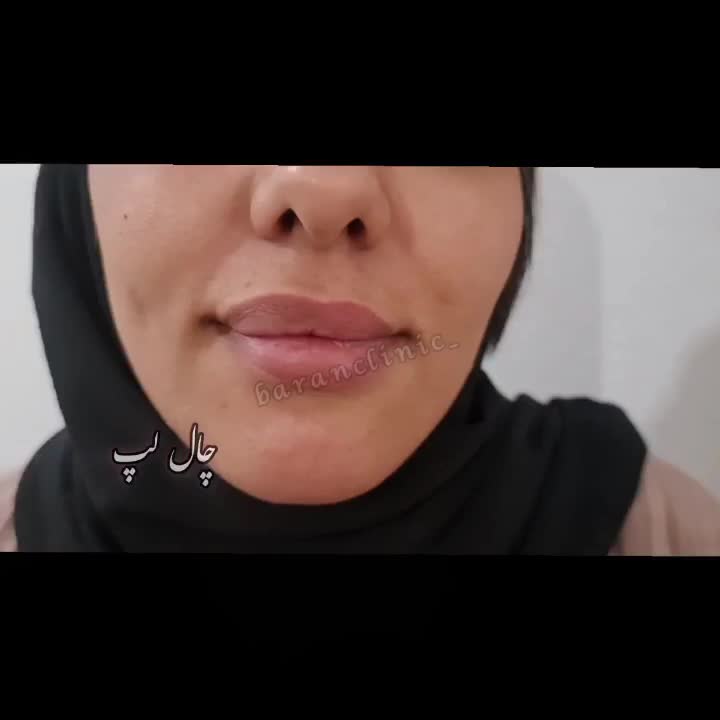 ژل بوتاکس چال لپ فیلربیکینی مزوتراپی پیرسینگ|خدمات آرایشگری و زیبایی|اسلام‌شهر, زرافشان|دیوار