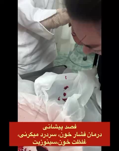 فصد پیشانی، حجامت، طب سوزنی|خدمات آرایشگری و زیبایی|شیراز, سینما سعدی|دیوار