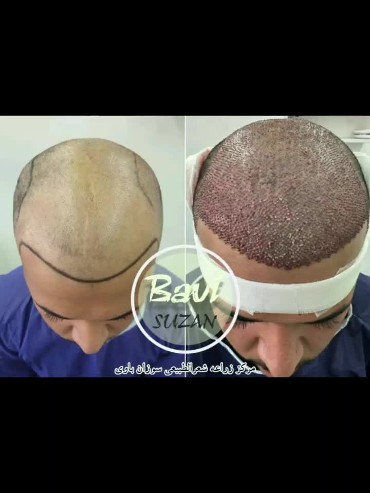 کاشت مو طبیعی سر و ابرو و ریش با ضمانت نامه کتبی|خدمات آرایشگری و زیبایی|اهواز, کیانپارس |دیوار