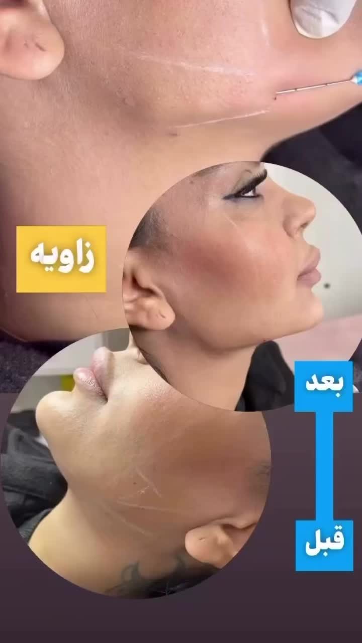 ژل لب ،زاویه سازی،فیلر چانه ،فول فیس|خدمات آرایشگری و زیبایی|مشهد, سجاد شهر|دیوار