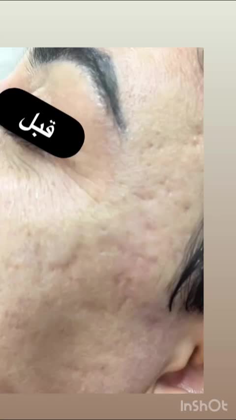درمان قطعی گودی و فرو رفتگی ناشی از جای جوش|خدمات آرایشگری و زیبایی|شیراز, ارم|دیوار