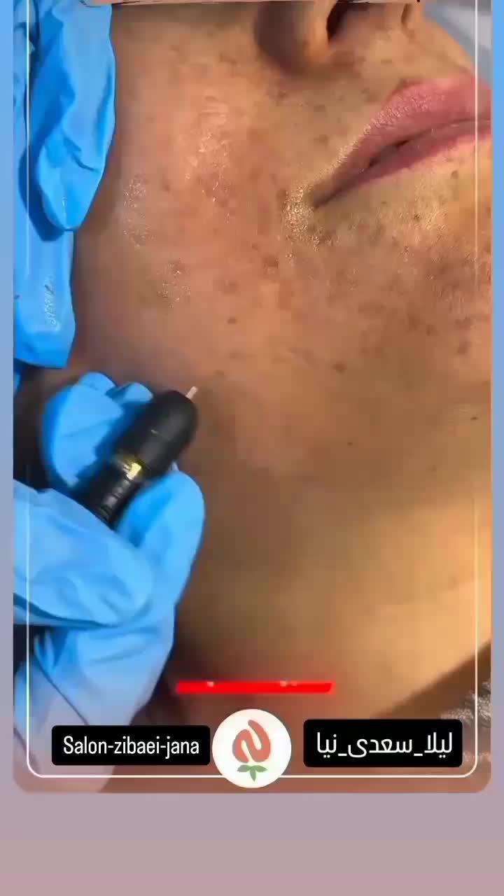 ابرو/لیزر پوست /شیدینگ/لیزر مو سفید/درمان کبد چرب|خدمات آرایشگری و زیبایی|خرم‌آباد, |دیوار