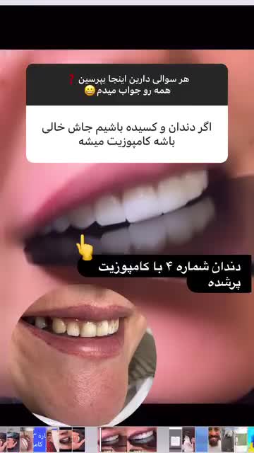 کامپوزیت دندان ، اصلاح طرح لبخند|خدمات آرایشگری و زیبایی|اصفهان, خواجو|دیوار