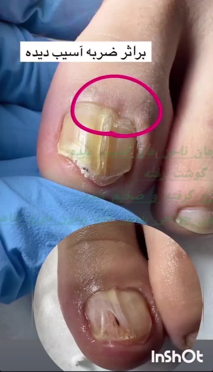درمان ناخن تو گوشت رفته و قارچ گرفته|آرایشی، بهداشتی، درمانی|ارومیه, |دیوار