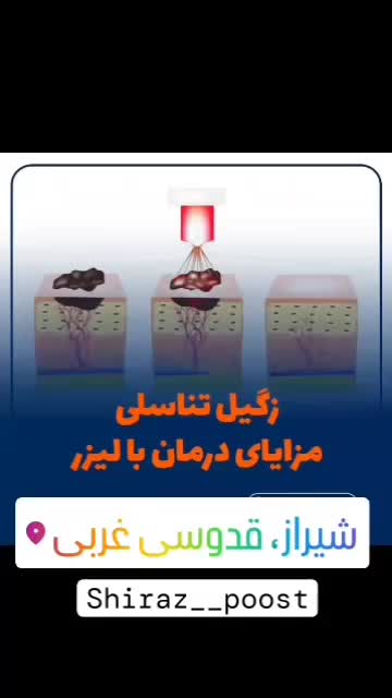 درمان زگیل تناسلی تک جلسه لیزر پیشرفته درمطب متخصص|خدمات آرایشگری و زیبایی|شیراز, قدوسی غربی|دیوار