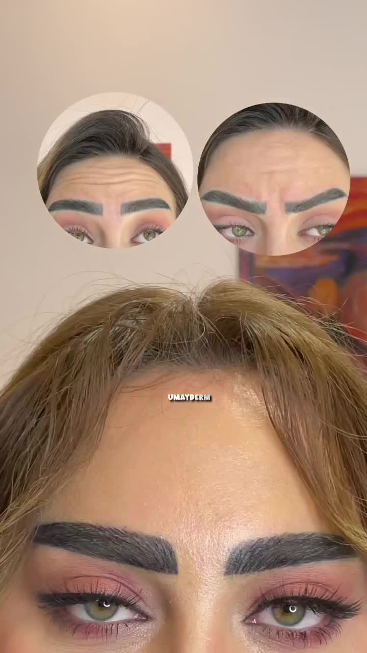 تخفیف پاییزی بوتاکس کلینیک زیبایی|خدمات آرایشگری و زیبایی|اردبیل, |دیوار