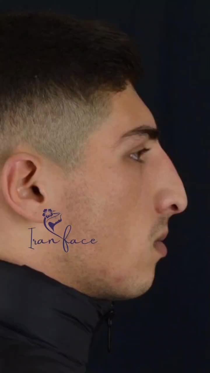 عمل بینی لیفت صورت اقساط تا۲۴ ماه|خدمات آرایشگری و زیبایی|تهران, تجریش|دیوار