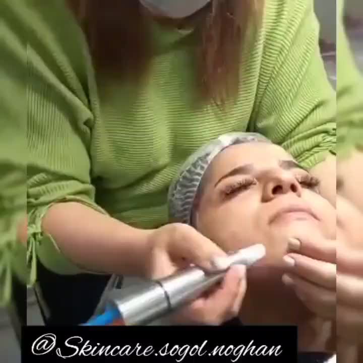 میکرونیدلینگ صورت|آرایشگاه و سالن‌های زیبایی|مبارکه, |دیوار