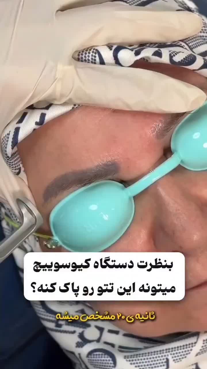 پاک کردن انواع تتو و بلفاروپلاستی در جنوب تهران|خدمات آرایشگری و زیبایی|باقرشهر, |دیوار