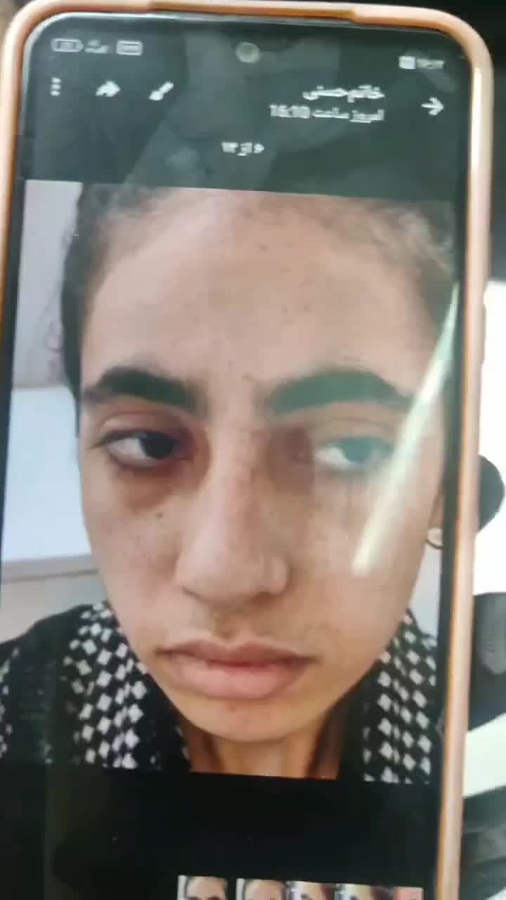 حذف دائمی کک و مک|خدمات آرایشگری و زیبایی|تربت جام, المهدی|دیوار