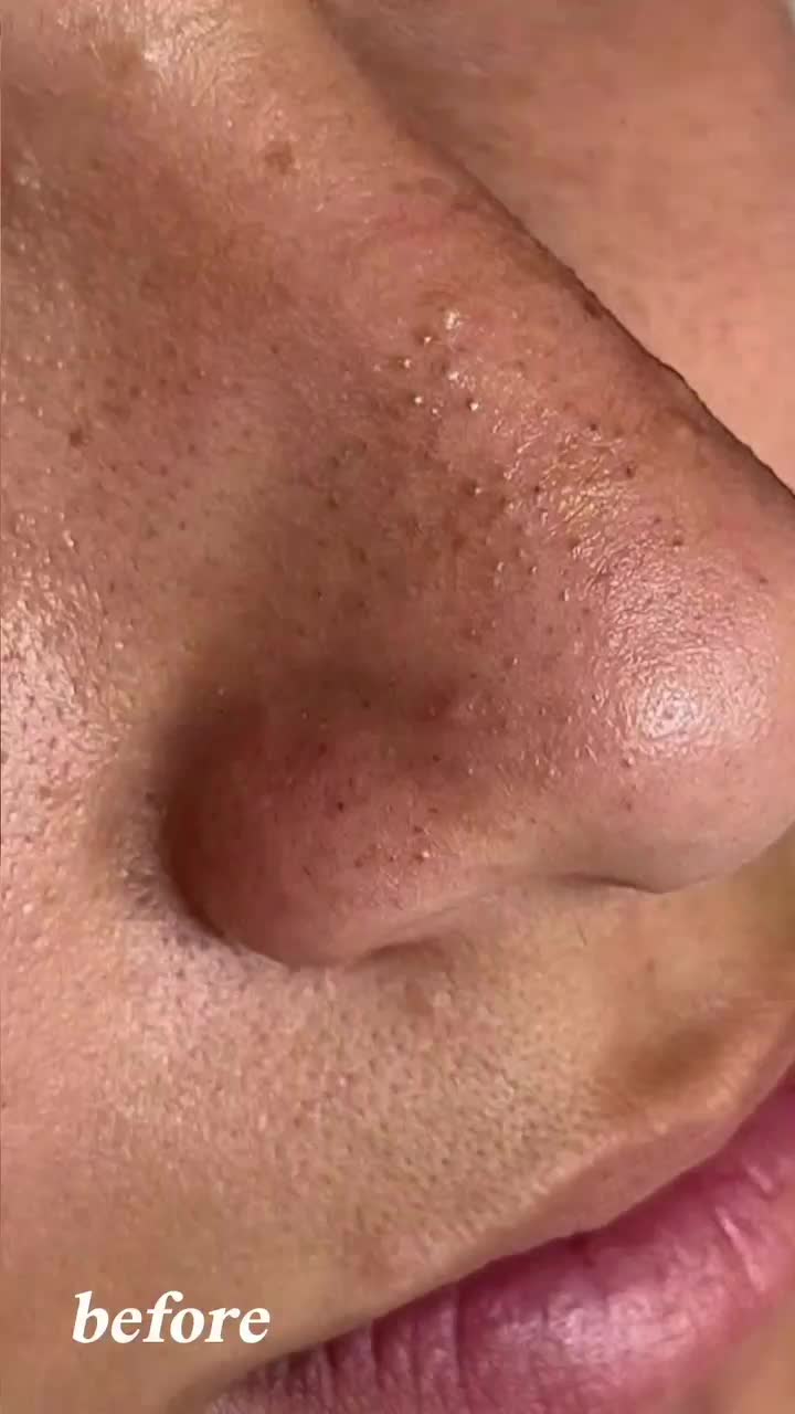 فیشال و پاکسازی تخصصی پوست|خدمات آرایشگری و زیبایی|میانه, |دیوار