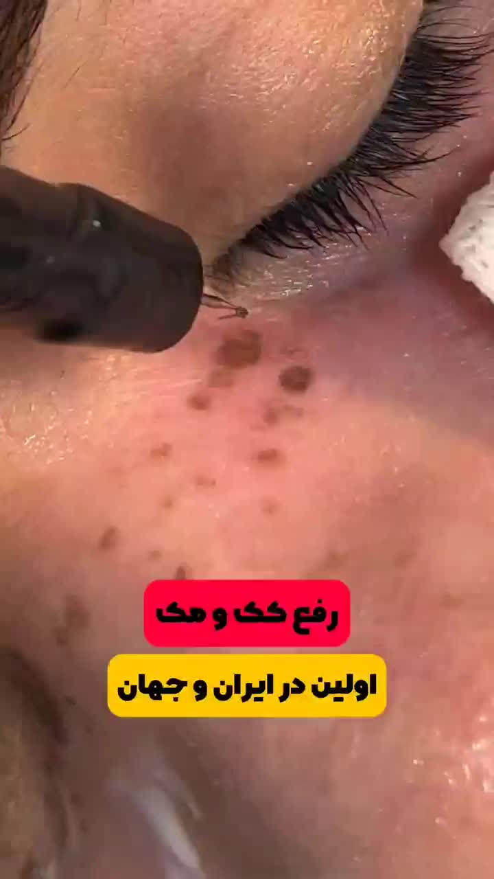 پاکسازی پوست درمان جوش جای جوش لک و کک ومک|خدمات آرایشگری و زیبایی|اصفهان, ملک‌شهر|دیوار