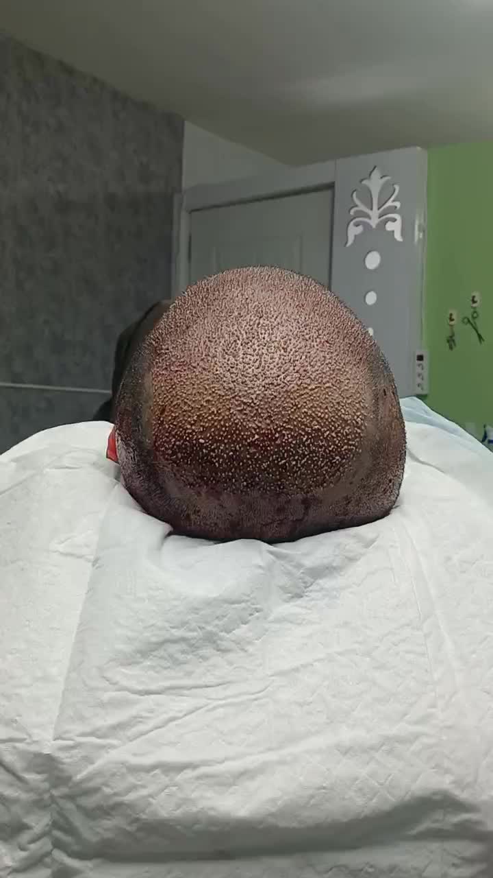 کاشت موی طبیعی فول تراکم|خدمات آرایشگری و زیبایی|ساری, |دیوار