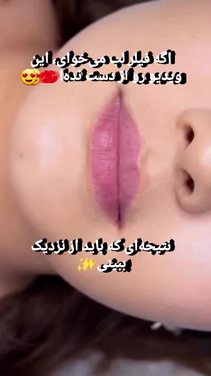 تخفیفات فیلر لب روسی، بادی،بوتاکس، نخ، توسط پزشک|خدمات زیبایی و سلامت|کرج, گوهردشت|دیوار