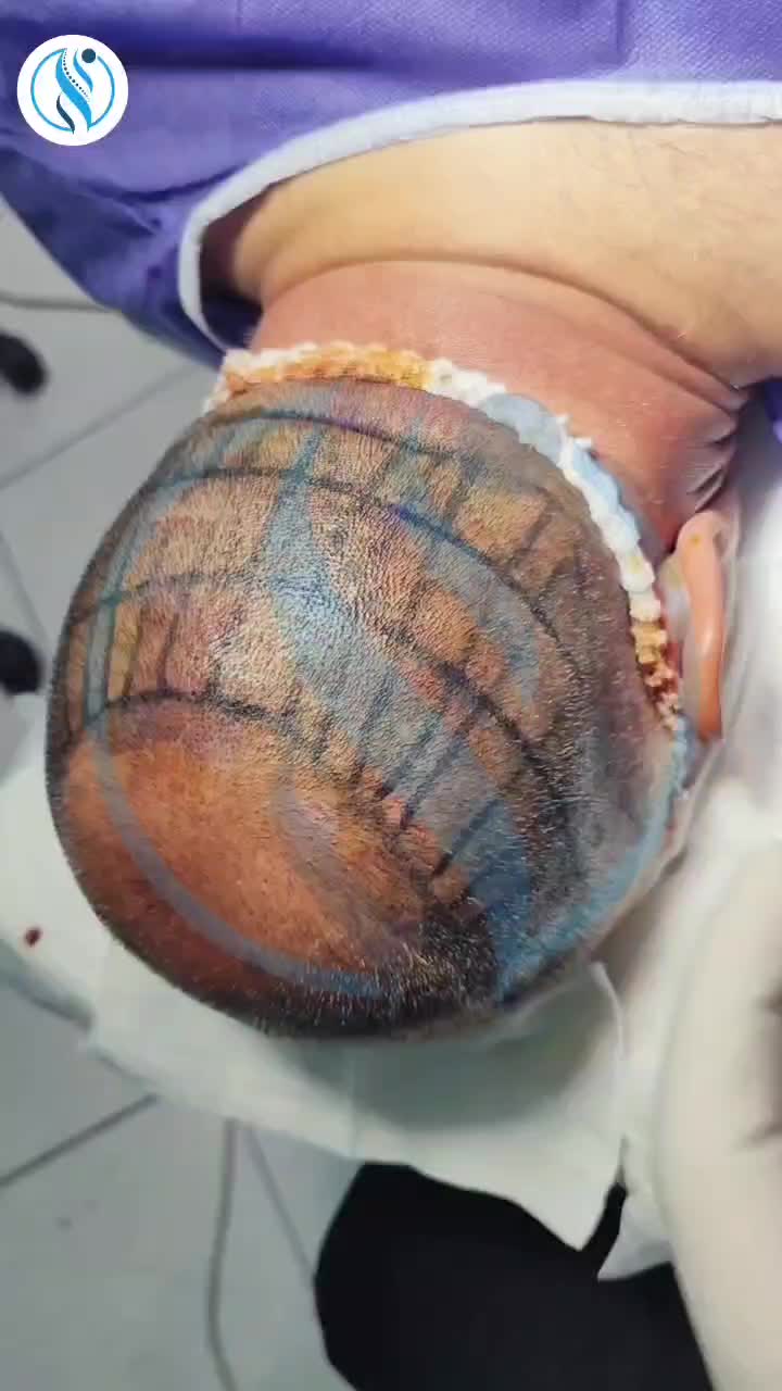 کاشت مو تنها با ۱۵ میلیون تومان|خدمات آرایشگری و زیبایی|بومهن, |دیوار