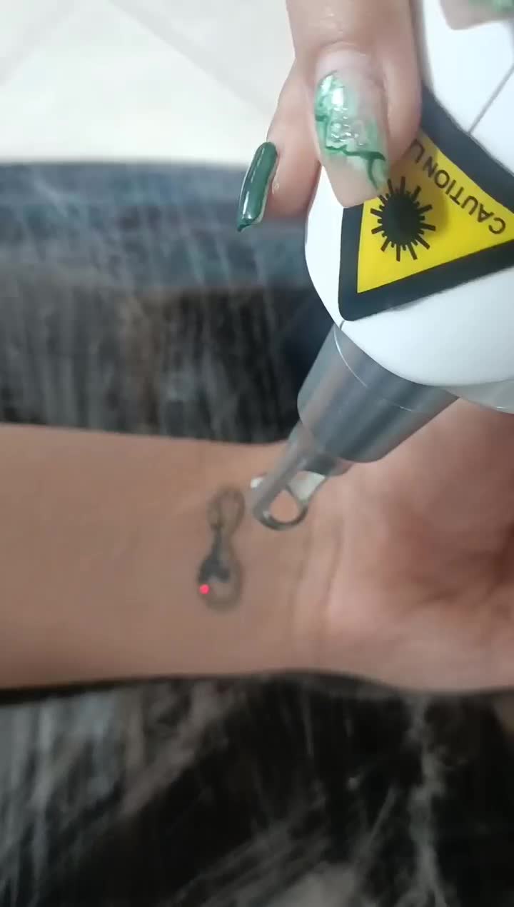 پاک کردن تاتو با دستگاه لیزر پیشرفته|خدمات آرایشگری و زیبایی|ماهدشت, |دیوار