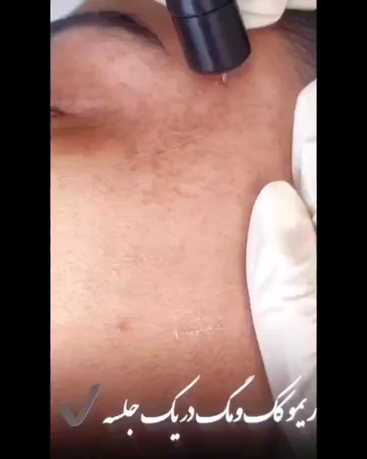 درمان تک جلسه ای تضمینی کک و مک ،لک،اسکار ،جوش|خدمات آرایشگری و زیبایی|قزوین, |دیوار