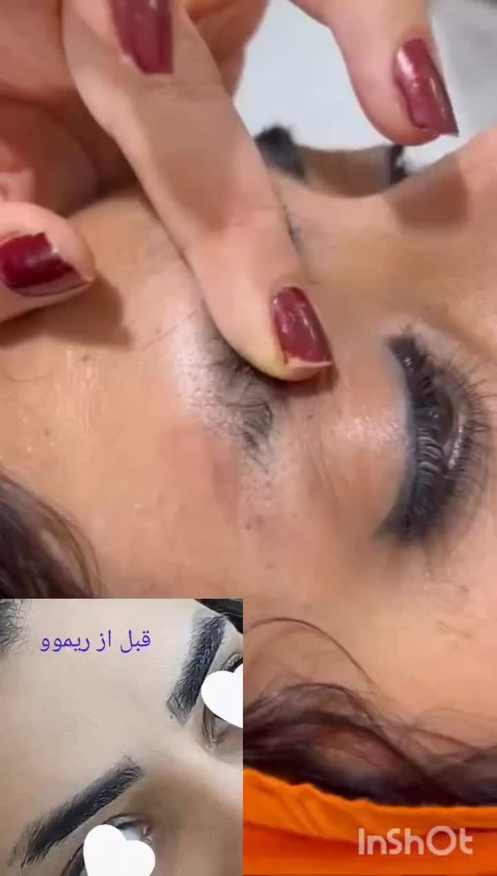 ریموو تک جلسه ای تضمینی|خدمات آرایشگری و زیبایی|مهران (ایلام), |دیوار