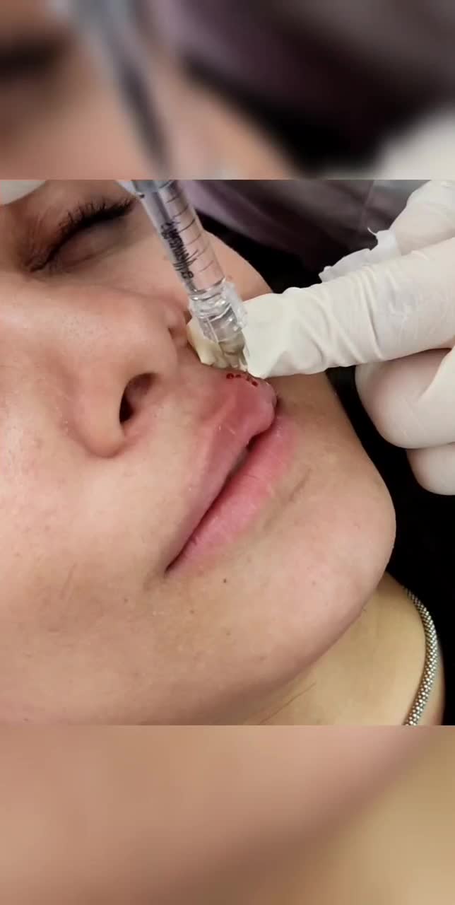 تزریق ژل وبوتاکس|خدمات آرایشگری و زیبایی|قم, بکایی|دیوار