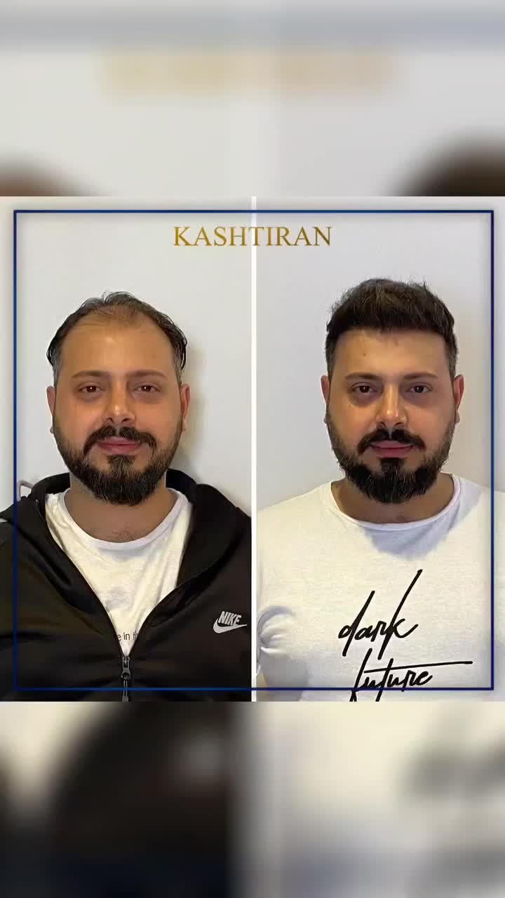 کاشت مو و ابرو و ریش بدون جراحی تراکم بالا|خدمات آرایشگری و زیبایی|تهران, الهیه|دیوار