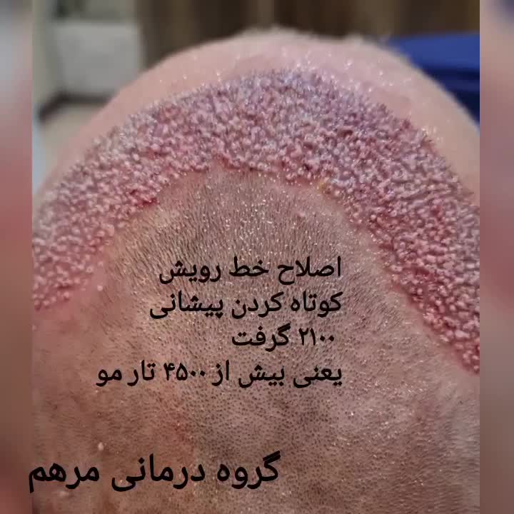 جشنواره کاشت مو در قم|خدمات آرایشگری و زیبایی|قم, میرزائیه|دیوار