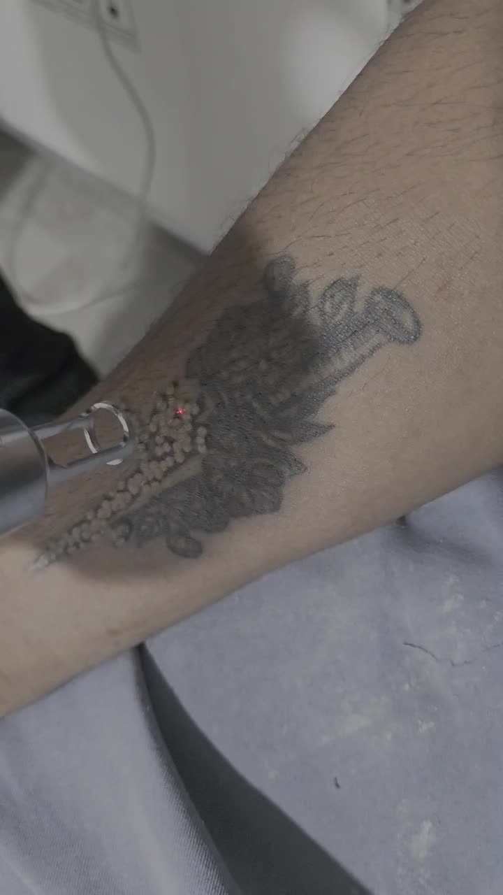 لیزر موهای زائد فسا پاک کردن تتو پلاژن تراپی|خدمات آرایشگری و زیبایی|فسا, |دیوار