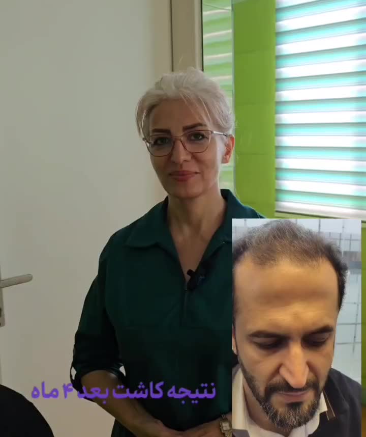 کاشت مو به روش شیرازی|خدمات آرایشگری و زیبایی|قم, زنبیل آباد|دیوار