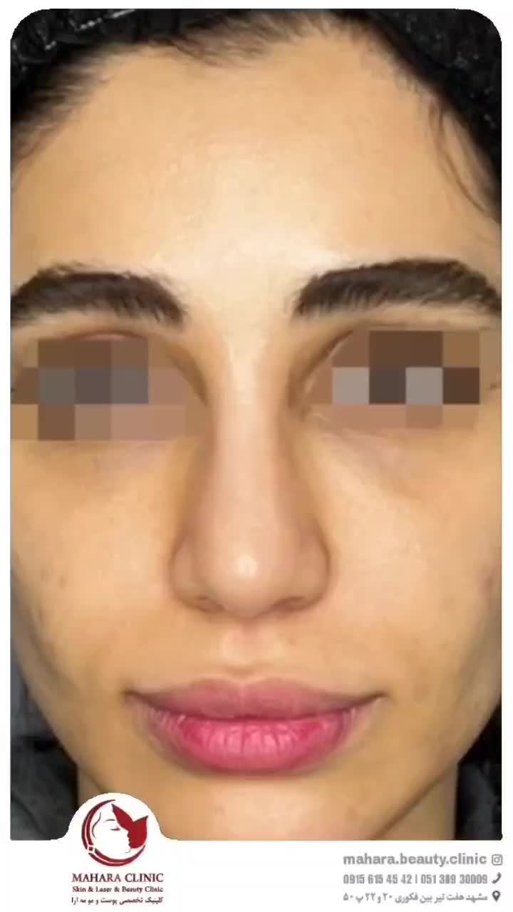 آف رینوپلاستی بینی بدون عمل جراحی NOA پزشک زیبایی|خدمات آرایشگری و زیبایی|مشهد, هفت تیر (آب و برق)|دیوار