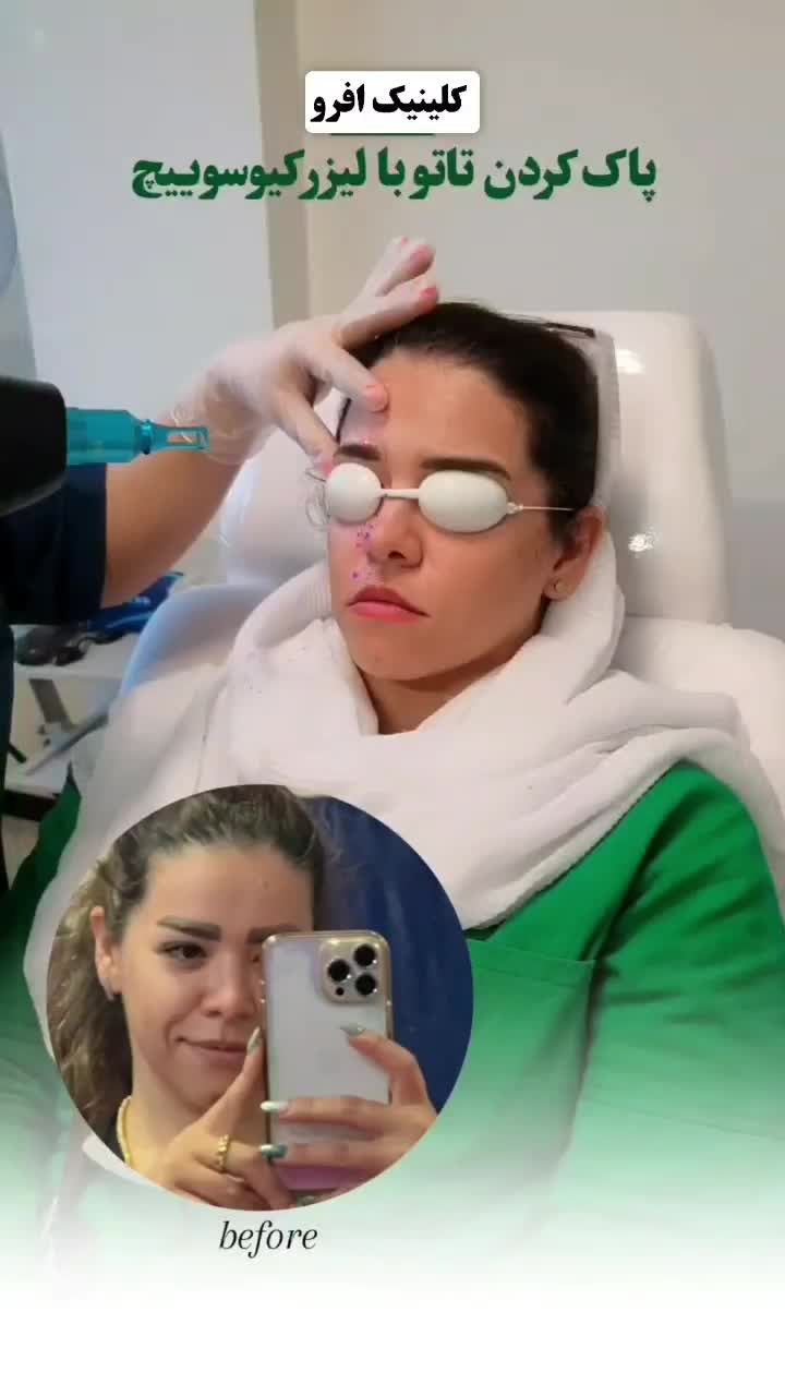 پاک کردن تتو با لیزر کیوسوییچ تضمینی|خدمات آرایشگری و زیبایی|تهران, نیروی هوایی (پیروزی)|دیوار