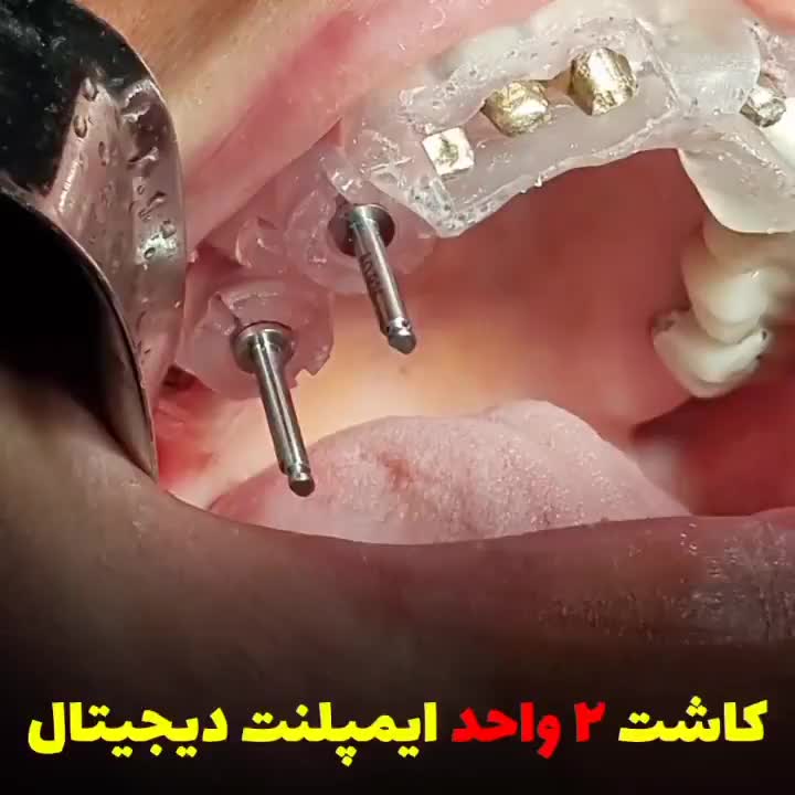 مرکزفوق تخصصی ایمپلنت دیجیتال/ایمپلنت فوری/بی درد|خدمات آرایشگری و زیبایی|مشهد, کوه سنگی|دیوار