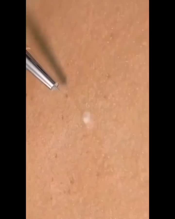 ست سوزن پاکسازی صورت در خانه|آرایشی، بهداشتی، درمانی|زنجان, |دیوار