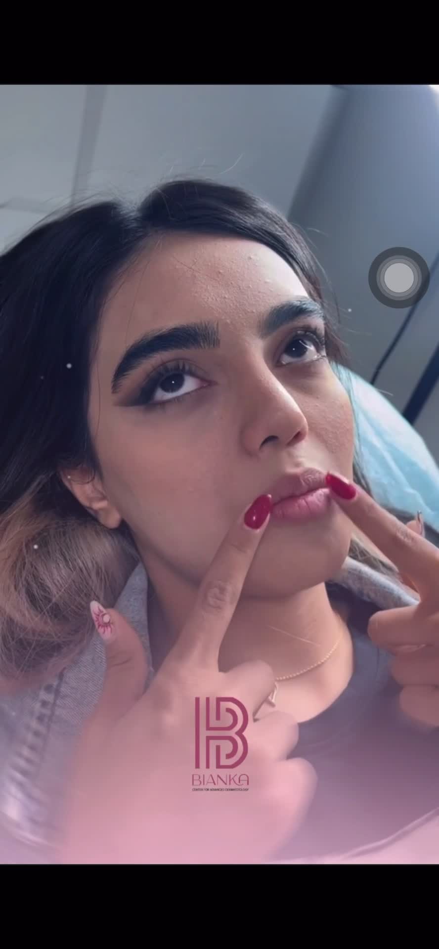 بوتاکس،فیلر توسط پزشک پوست و زیبایی(تخفیف استثنایی|خدمات آرایشگری و زیبایی|تهران, دروس|دیوار