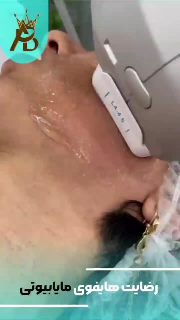 جوانسازی قوی  لیفت صورت ،روشن کننده هایفوتراپی|خدمات آرایشگری و زیبایی|یاسوج, |دیوار