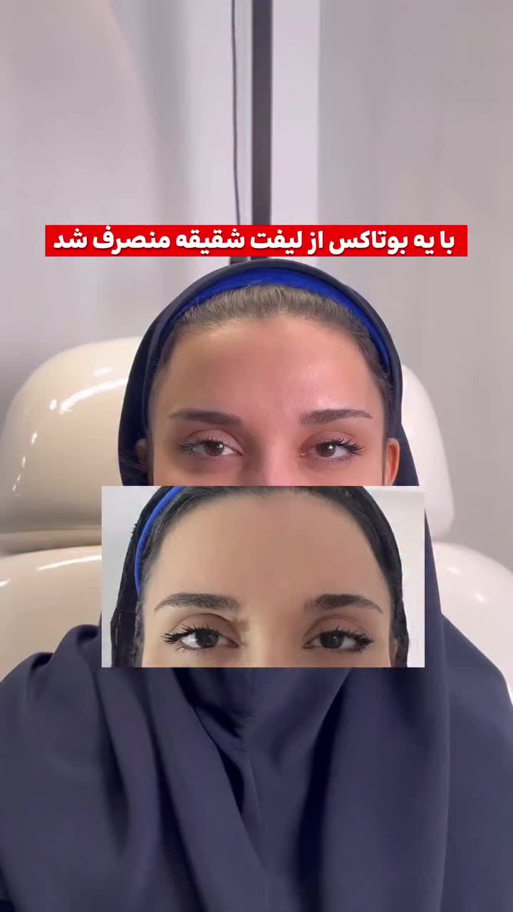 جشنواره ۶۰٪  بوتاکس فول‌فیس - برج ماندگار عظیمیه|خدمات آرایشگری و زیبایی|کرج, عظیمیه|دیوار