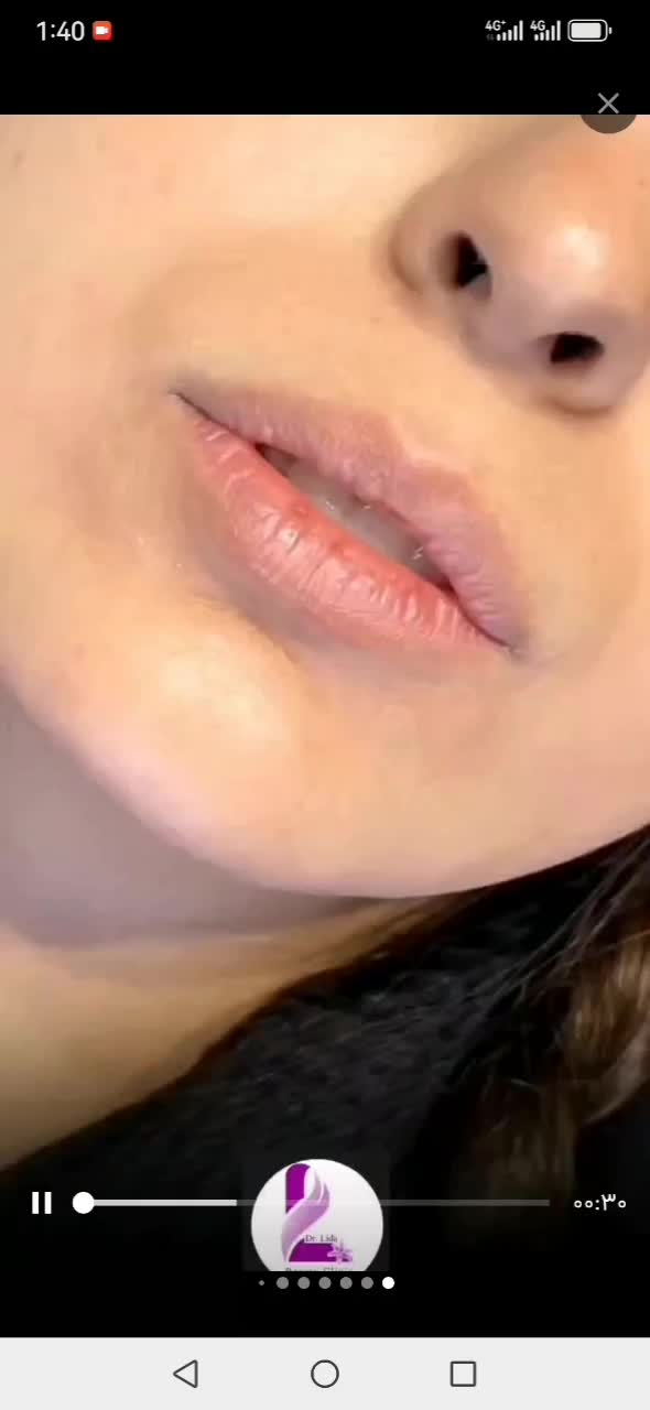 تزریق چربی، ژل وبوتاکس ومادلینگ صورت توسط پزشک|خدمات آرایشگری و زیبایی|کرمانشاه, |دیوار