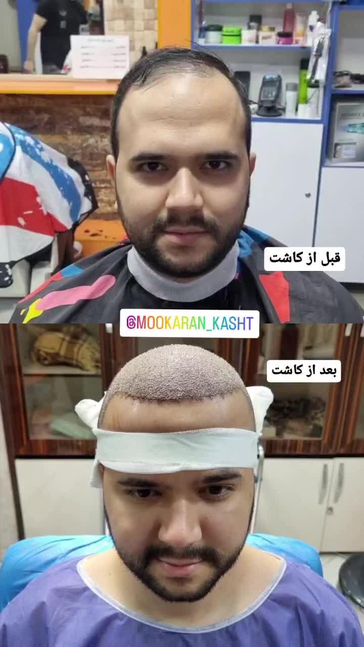 کاشت مو تراکم بالا (بدون تراشیدن سر)|خدمات آرایشگری و زیبایی|محمدشهر, |دیوار