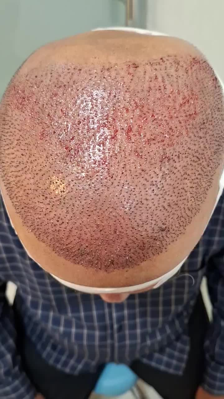 کاشت مو طبیعی در بوشهر وشیراز|خدمات آرایشگری و زیبایی|بوشهر, |دیوار