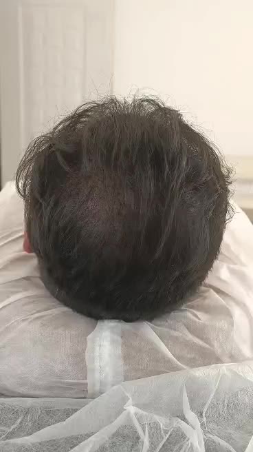 میکرواسکالپ،پرپشتی مو تضمینی|خدمات آرایشگری و زیبایی|مشهد, صیاد شیرازی|دیوار