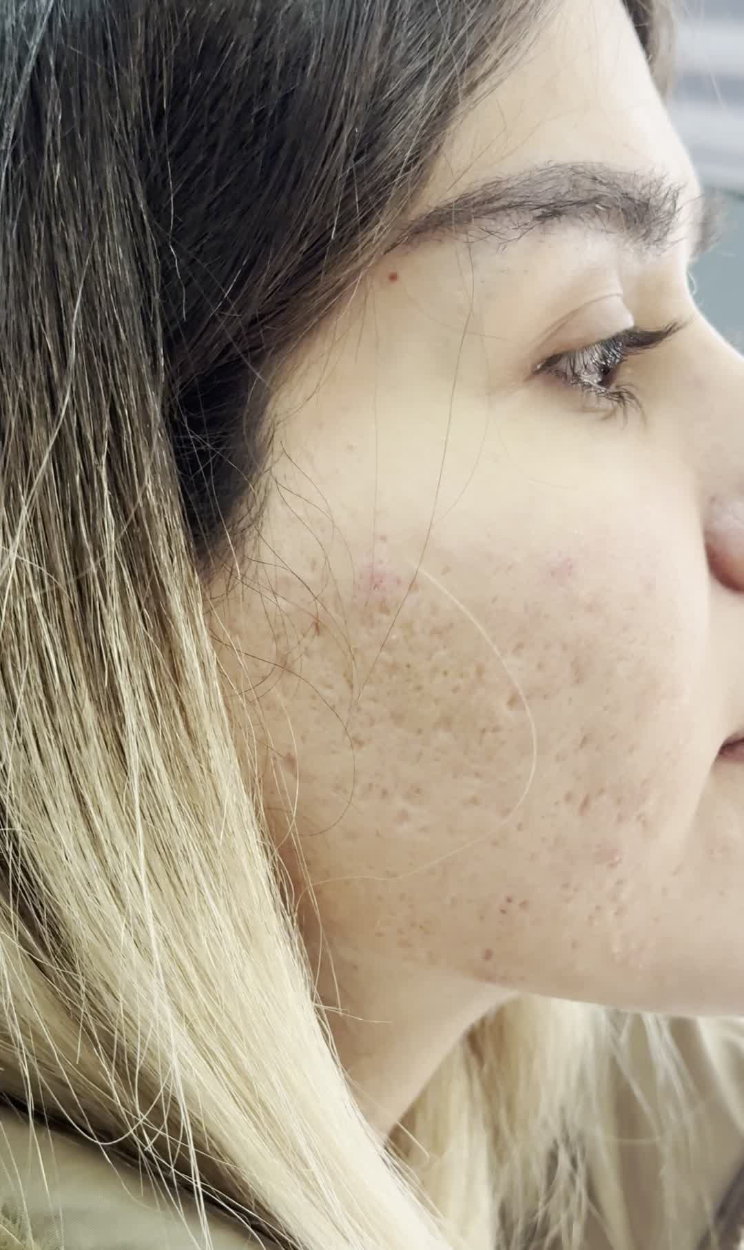 لیزر co2 تخفیف ویژه حذف اسکار،منافذوتیرگی ها مزو|خدمات آرایشگری و زیبایی|تهران, زعفرانیه|دیوار