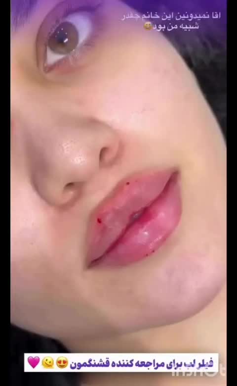 لیزر پی ار پی ژل فیلر بوتاکس لیفت نخ پی ارپی prp|خدمات آرایشگری و زیبایی|مشهد, هفت تیر (حافظ)|دیوار