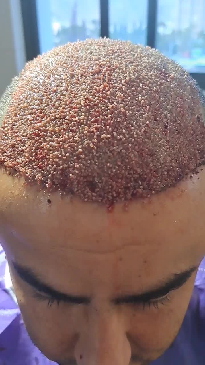 کاشت مو /کاشتمو/کاشتمو شیراز|خدمات آرایشگری و زیبایی|شیراز, قصرالدشت|دیوار