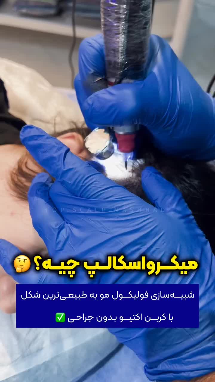 رفع کمپشتی مو با تکنیک میکرو اسکالپ /مکمل کاشتمو|خدمات آرایشگری و زیبایی|مشهد, احمدآباد|دیوار